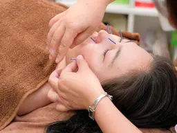 No.1メニュー　✨美容鍼灸✨初回半額！