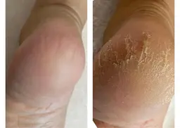 かかと角質ケア&マッサージ