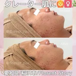 【ミニモ限定】痛みなし！ダウンタイムなし！剥けない次世代ハーブピーリング