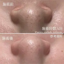 毛穴ハイドロピーリングトリートメント