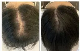 ヘッドグロウ★【頭皮集中ハーブピーリング】