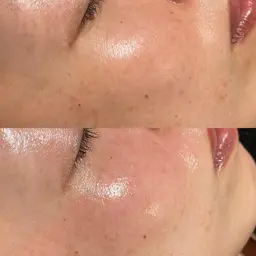 ララピール　近赤外線LEDコラーゲン付き✨