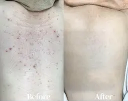 痛みなし！ダウンタイムなし！背中ピーリング❣️