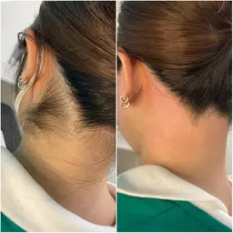 うなじワックス✨髪を結んだ時に気になるうなじをワックス脱毛で綺麗に🫰🏻💗