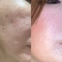 メンズOK!ニキビ、クレーター、毛穴にお悩みの方に効果絶対！ハーブピーリング（剥離あり）