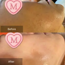 ダウンタイムなし❤️ニキビ肌荒れ解消スペシャル⭐️生コラ導入付【ニキビ吹き出物、ニキビ痕】お茶カウンセリング込120分