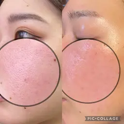 【最新肌管理🇰🇷🌿】ダクトピール✨ニキビ・肌荒れ・黒ずみ・くすみ