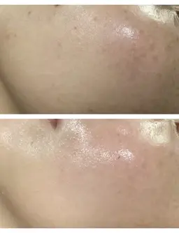 【シミケア/美白】水光肌ホワイトピール/ハイドロリンパ排泄コース¥5500✨