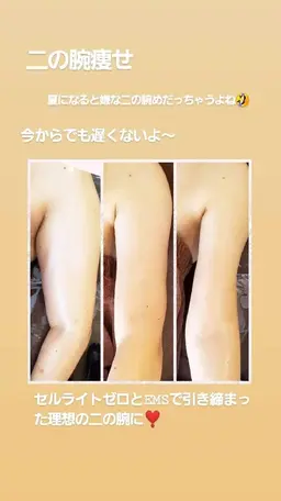 【1ヶ所体験】セルZERO(二の腕 お腹 背中ets)《キャビ+ラジオ波+サイクロン》