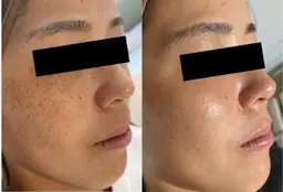 シングルラッシュ付け放題➕光フェイシャル