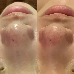 フェイシャルプチ