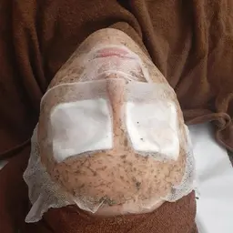 ⭐お得コース⭐　3回チケット　ハーブピーリング🌿　ハードコース