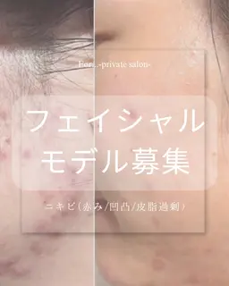 🫧【モデル募集】毛穴つるん♡角栓クリア40分(クレンジング→悩み別ピーリング→マスク→仕上げ)