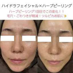 【初回体験】徹底毛穴！ツルピカ水光肌✨ハイドラフェイシャル&ハーブピーリング🌿