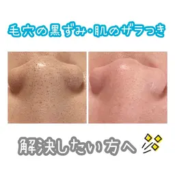 本気で肌を綺麗にしたい！そんな方にオススメ毛穴洗浄‼️✨️