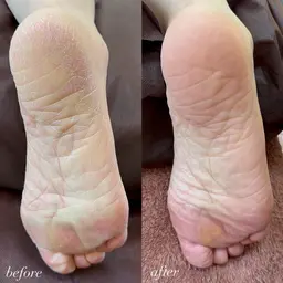 フット角質ケア