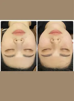 結果重視❗️5名様限定‼️1月特典💆‍♀️💗小顔ケア4000ショット‼️特別価格にて🥰