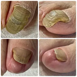 無料モデル募集！変形爪、肥厚爪、タコ、魚の目4月17日、24日限定