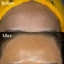 マリムーブフェイシャルwax脱毛