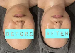 「肌を磨き上げ、育て上げる」　第５世代ピーリング【陶肌ピール】　首・肩・デコルテの15分マッサージ付き♪