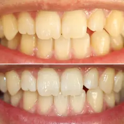 セルフホワイトニング15分×3回