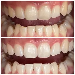 【期間限定👀】歯の黄ばみにホワイトニング体験メニュー🦷8分×3回で効果実感✨セルフで簡単本格ケア💎