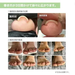フットネイル 巻き爪矯正（親指のみ）