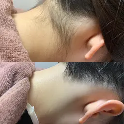 💎当店人気NO.2💎✮うなじ脱毛1回✮ ✔︎シェービング+保湿付き 形相談して決めましょう♪