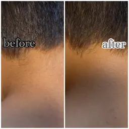 キッズ脱毛✨脱毛箇所お選び頂けます🌻