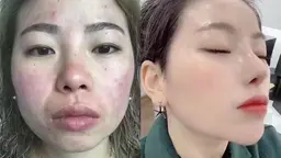 ★毎月先着3名様★話題の最新ハーブピーリング特別価格！66,000円→29,800円