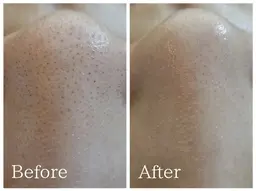 毛穴洗浄フェイシャル初回1回