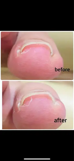 巻き爪ケア(1本)