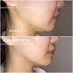 満足度100%！【小顔★フェイスラインの脂肪ぶんかい】気になる二重顎やフェイスラインをスッキリ横顔美人に♪