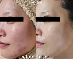 🌿【肌荒れ・ニキビ・赤み】天然ハーブで炎症を落ち着かせる肌質改善ケア