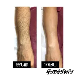 腕脱毛(手の甲･指,両ヒジ上･下)