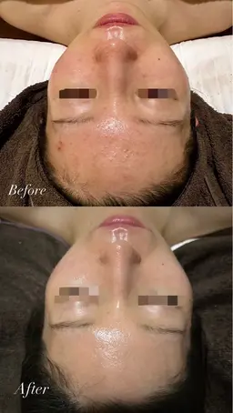 【ニキビ/毛穴改善】人生最後のニキビケア◎剥けないハーブピーリング