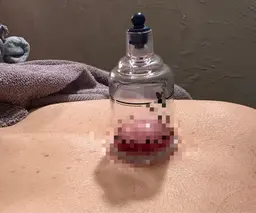 デトックスカッピング全身鍼灸