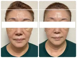 【エイジングケア】最強リフトアップトリートメント❤️当店人気No.1のフェイシャルメニュー