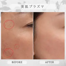 💎美肌プラズマ💎《シミ・黒ずみが気になる方》
