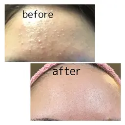 ◆ミニモ学割【本気の肌管理】リフトアップ＋イオン導入▼肌質分析込み