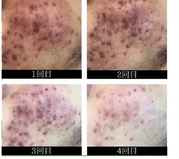 ハーブピーリング🌿痛くない/剥離無/ダウンタイム無【ニキビ/毛穴に特化した施術/皮膚科で治らないニキビおまかせください