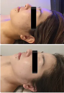 【お疲れ顔には】背中コルギ＋姿勢矯正＋フェイシャルコルギのトリプルですっきり小顔＆すっきり上半身