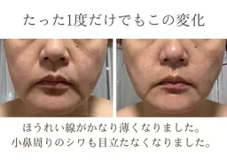 【結果重視】プレミアム幹細胞美容液導入☆しみ、しわ、美白改善コース体験💆‍♀️✨️