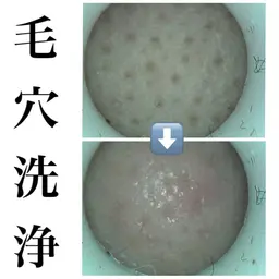【毛穴】黒ずみや開きには毛穴洗浄🫧毛穴スコープで肌診断付き🔍