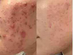 ハーブピーリング【選べる剥離】