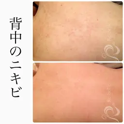 背中ケア‼️リベルハーブピーリング🌿気になる背中も憧れのスベスベ肌へ🥚✨背中ニキビ、毛穴、ザラ付きに◎