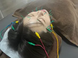 《美容鍼》電気パルス・首調整・ヘッドマッサージ付き