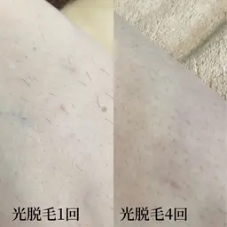 【メンズ脱毛】全身(顔VIO除く全て)