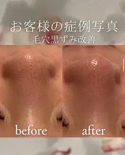 【毛穴黒ずみオフ】大人の毛穴悩みに!皮脂詰まり黒ずみ撃退🔥