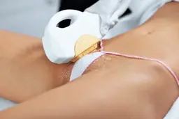 エステ以上【美療VIO脱毛】エステ唯一の抜け&くすみケア、美肌！毛の復活も無く粘膜までOK